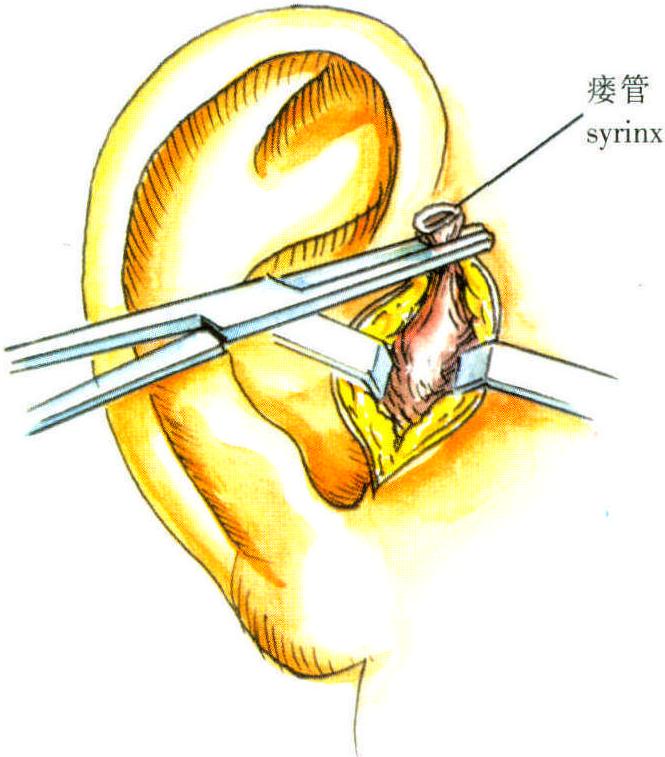 先天性耳前瘘管摘除术